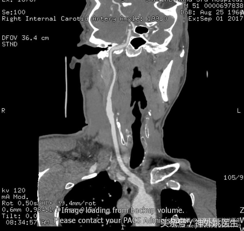 颈内动脉狭窄可以做内膜剥脱术吗,颈内动脉内膜剥脱手术指征