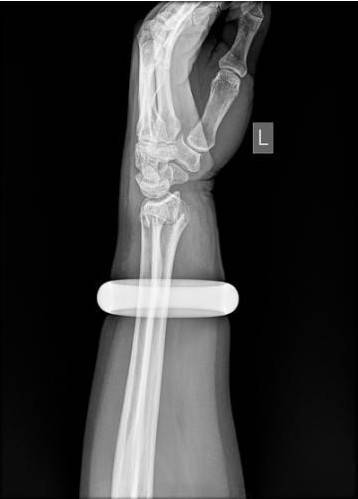 30万玉镯被打碎怎么处理,玉镯被砸掉