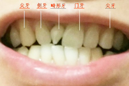 遇上门牙旁长小尖牙，医生教你怎么处理