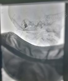 耳后的“血包“——神经外科医生巧判断，多学科会诊解难题