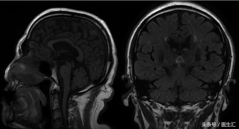 进行性核上性麻痹综合征,进行性核上性麻痹存活寿命