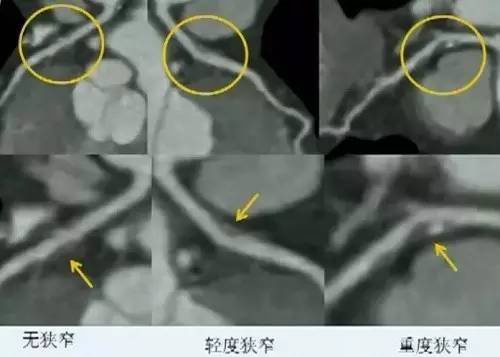 微课堂牢记三要诀，轻松看懂冠脉CTA