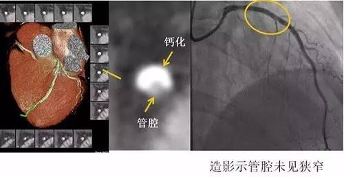 微课堂牢记三要诀，轻松看懂冠脉CTA