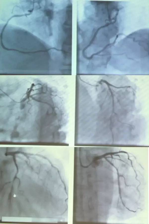 brugada三种形态的心电图,心电图查出brugada混合型严重吗
