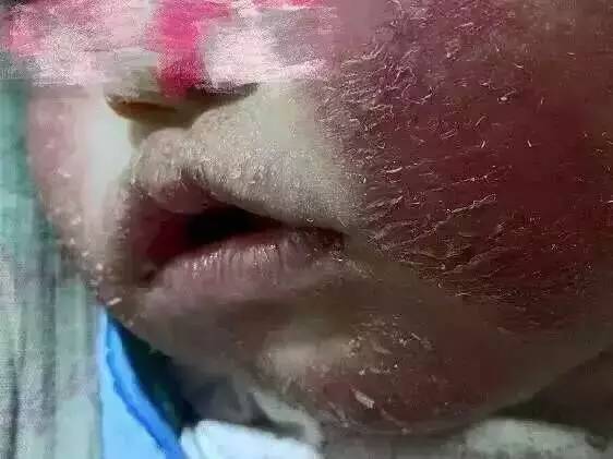 为什么这么容易得激素脸,特别严重的激素脸怎么治