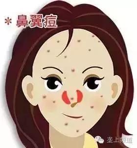 脸上长痘痘可以用醋洗脸吗,用醋洗面会长痘