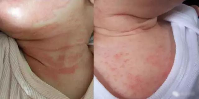 湿疹宝宝可以洗澡吗崔玉涛,崔玉涛治疗湿疹的最佳方法