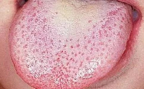 地图舌草莓舌儿童怎么调理,草莓舌锯齿舌和地图舌怎么缓解