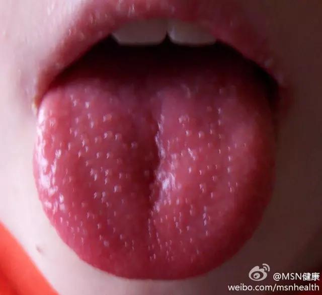 地图舌草莓舌儿童怎么调理,草莓舌锯齿舌和地图舌怎么缓解