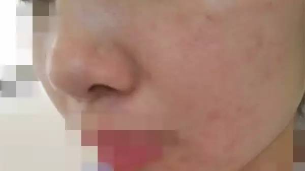 为什么这么容易得激素脸,特别严重的激素脸怎么治