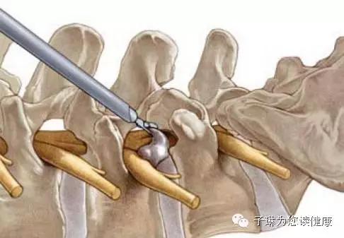 如此严重的腰椎间盘突出症，没开刀，但是治好了