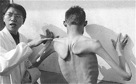 干细胞治疗肌营养不良症临床试验,肌营养不良干细胞最新突破