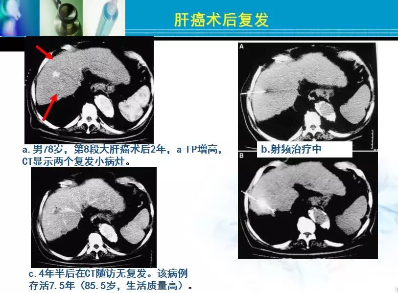 胆管肿瘤射频消融术,肿瘤射频消融厂家