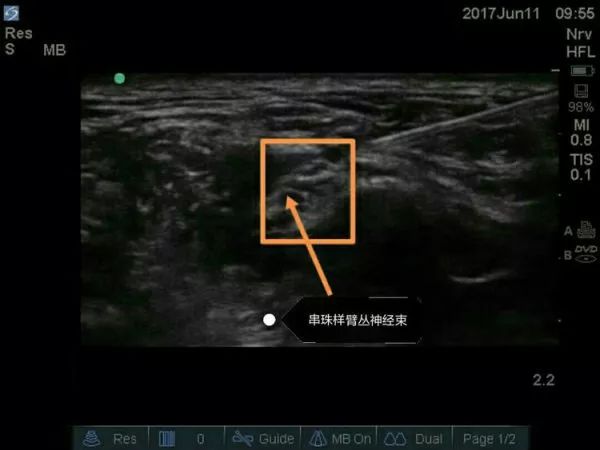 超声引导隐神经阻滞视频教学,超声引导下腰椎旁神经阻滞视频