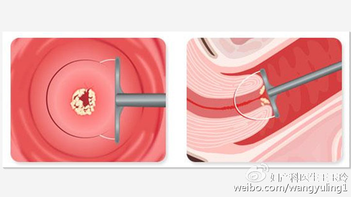 治疗“宫颈糜烂”,这个药被滥用了很多年
