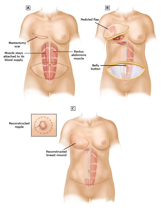乳房全切和乳房重建能同时手术吗,乳房重建切口