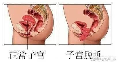 产后如何防止子宫下垂的发生,产后如何防止子宫下垂