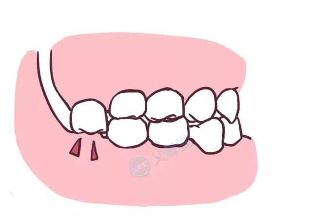 牙齿缺损能通过种植牙解决吗,牙齿缺损可以直接拔掉吗