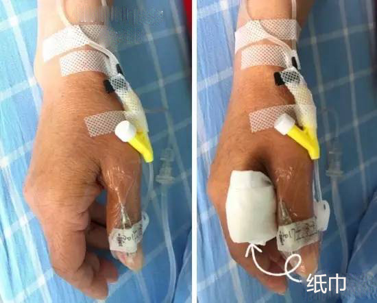 输液扎针技巧看不到血管,输液扎针的视频教程
