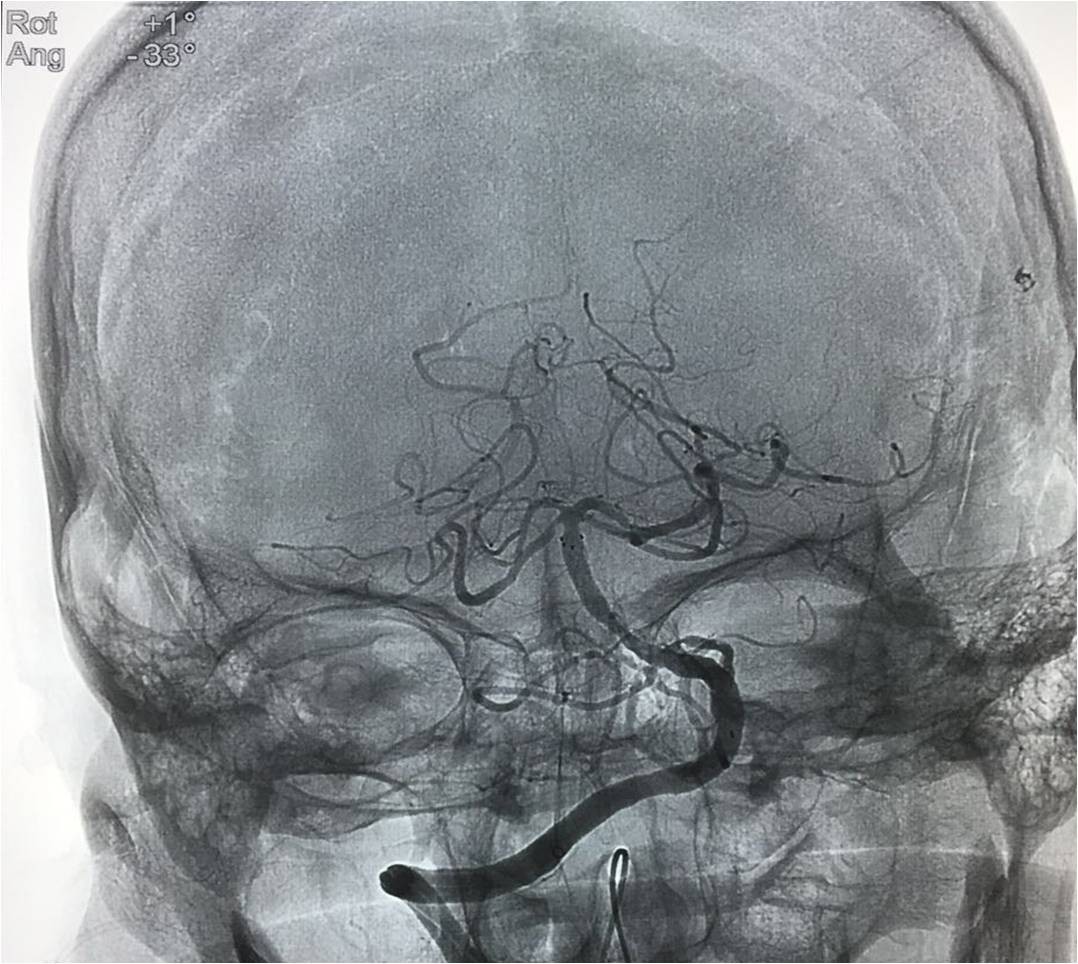 取栓慢性闭塞如何避免血栓逃逸,急性大脑中动脉栓塞取栓时间