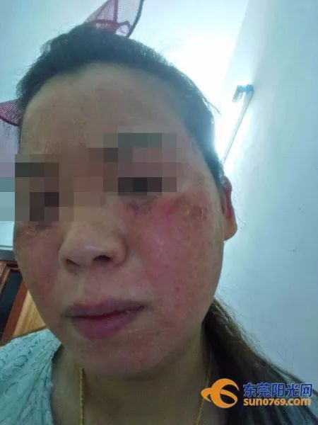 面部祛斑遭毁容,祛斑毁容真实案例