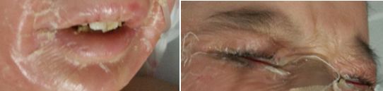 皮疹不吃药能自愈吗,皮疹一天就自愈了