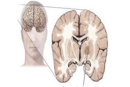 脑膜瘤术后怎么防止复发,脑膜瘤术后复发有哪些症状