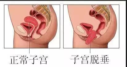 绝经后,子宫也会给你发出“警报”