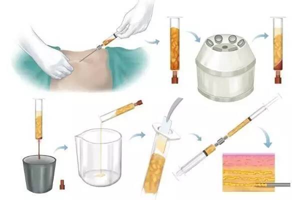 自体脂肪填充川字纹保持多久,自体脂肪填充10天内效果图