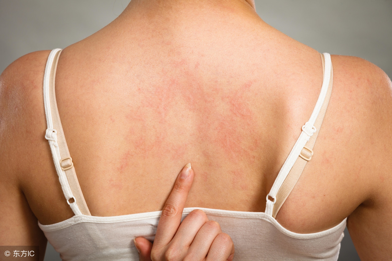 「1药说」艾洛松（糠酸莫米松乳膏）可以长期使用吗？