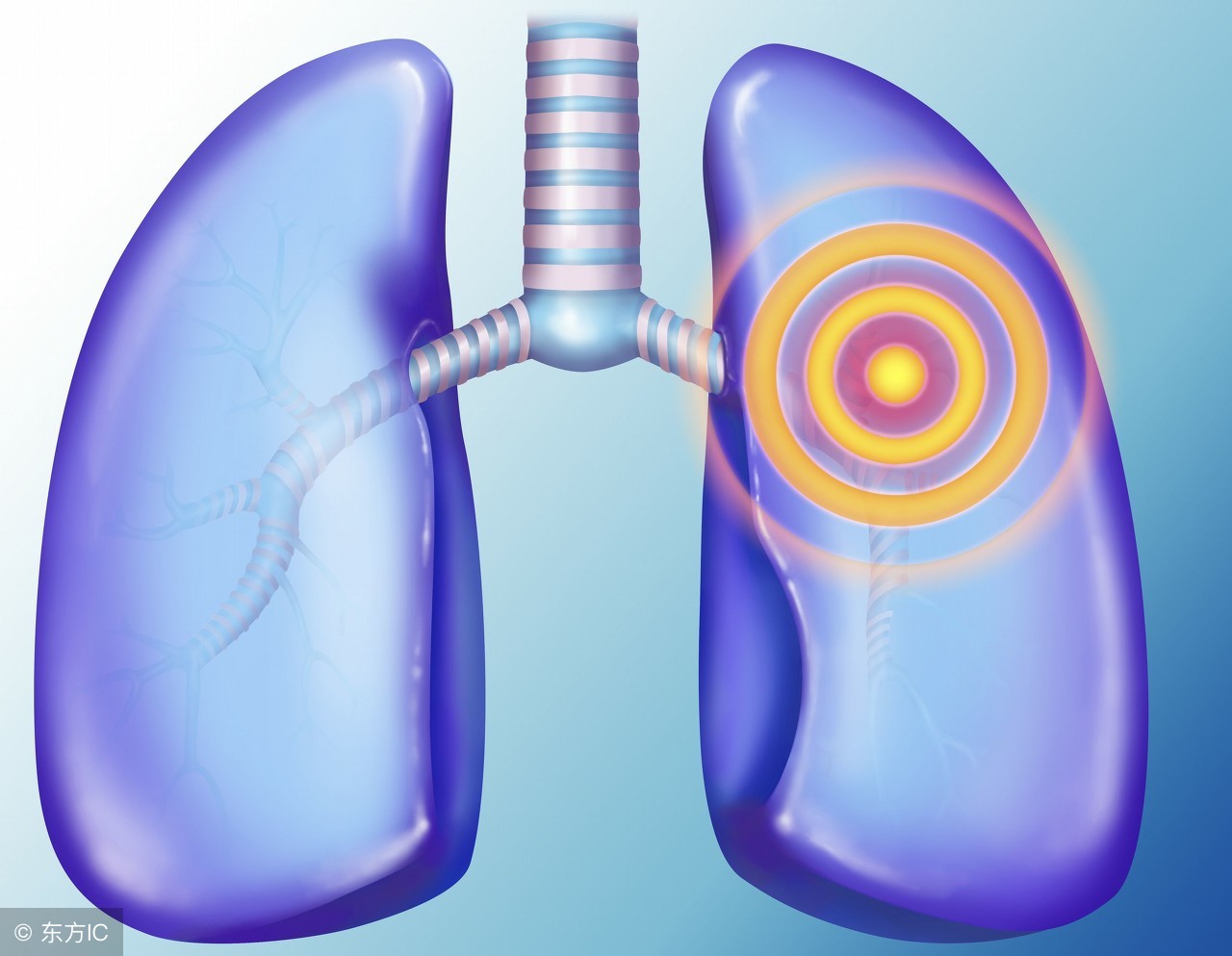 重症流感的症状,重症流感应采取几级防护