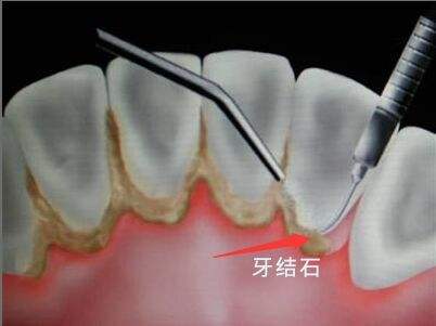 他的经历告诉你：不育的人治牙后也能有宝宝