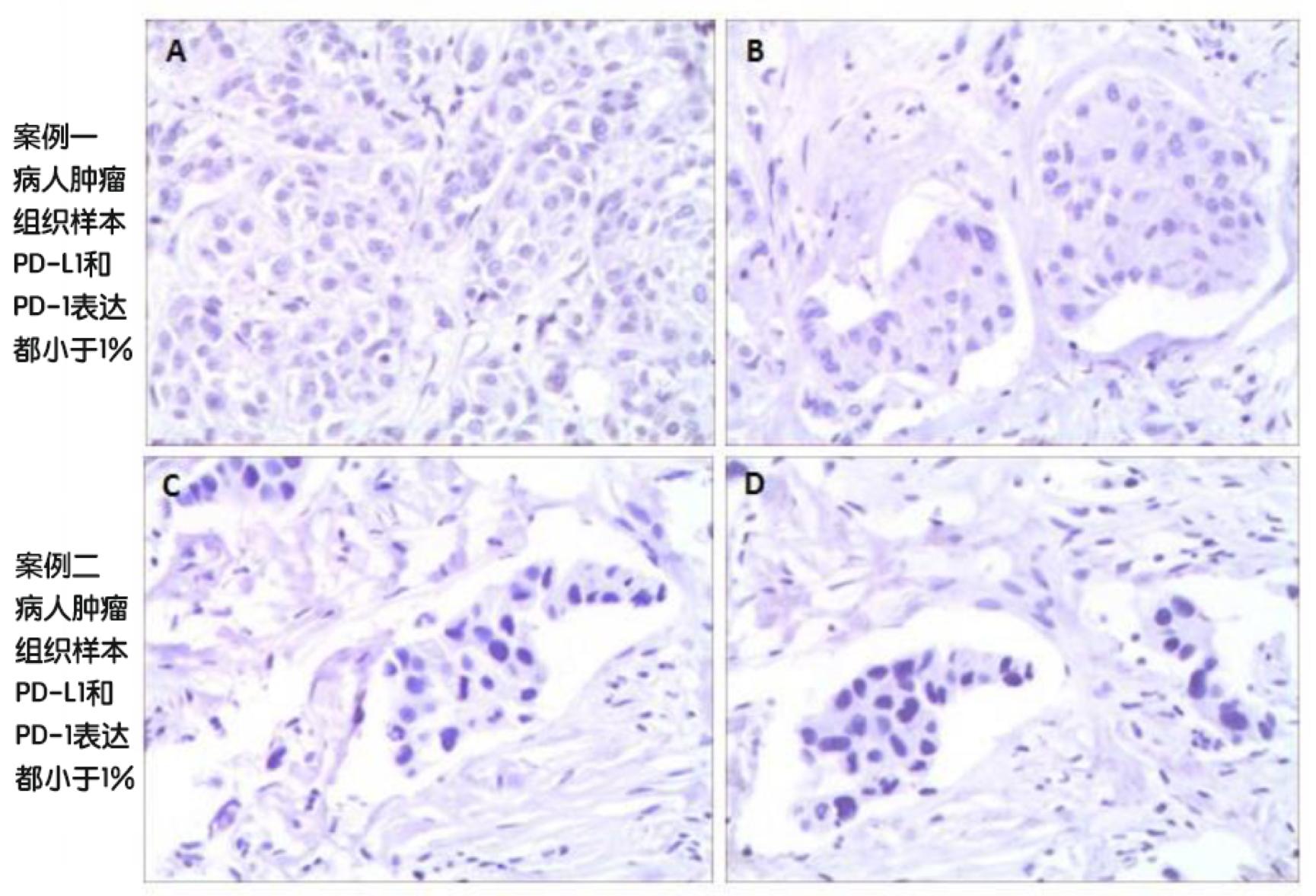 pd1联合紫杉醇卡铂治疗肺癌,pd-1和化疗哪个副作用大
