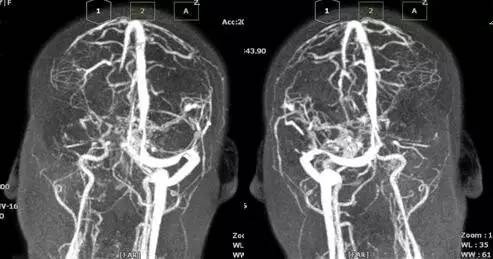 颅内静脉窦血栓ct特征,颅内静脉窦血栓的定性诊断