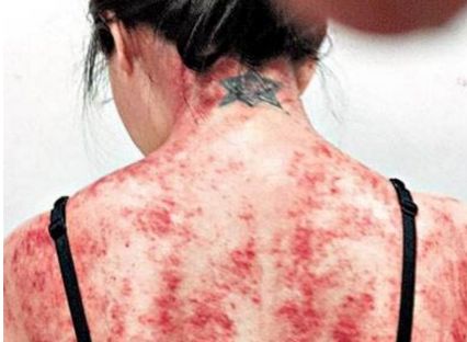 闃垮▏鏅掑埉鐥ф不鐤楃収,闃垮▏鑴搁儴鍒棫