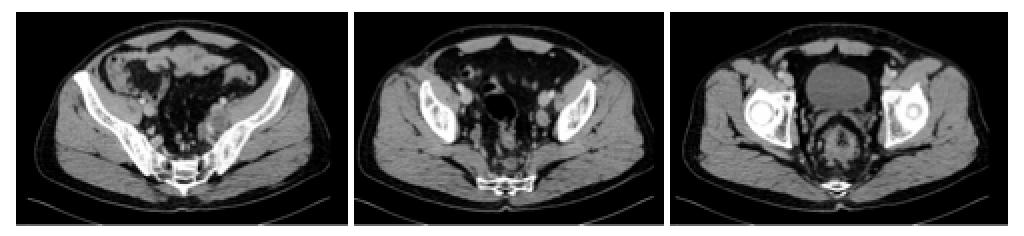 直肠腺癌肺转移最好的治疗方案,得了直肠腺癌不治疗能活几年