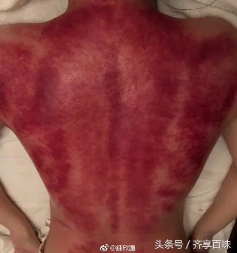 37岁阿娇身体越来越差刮痧晒后背照网友心疼