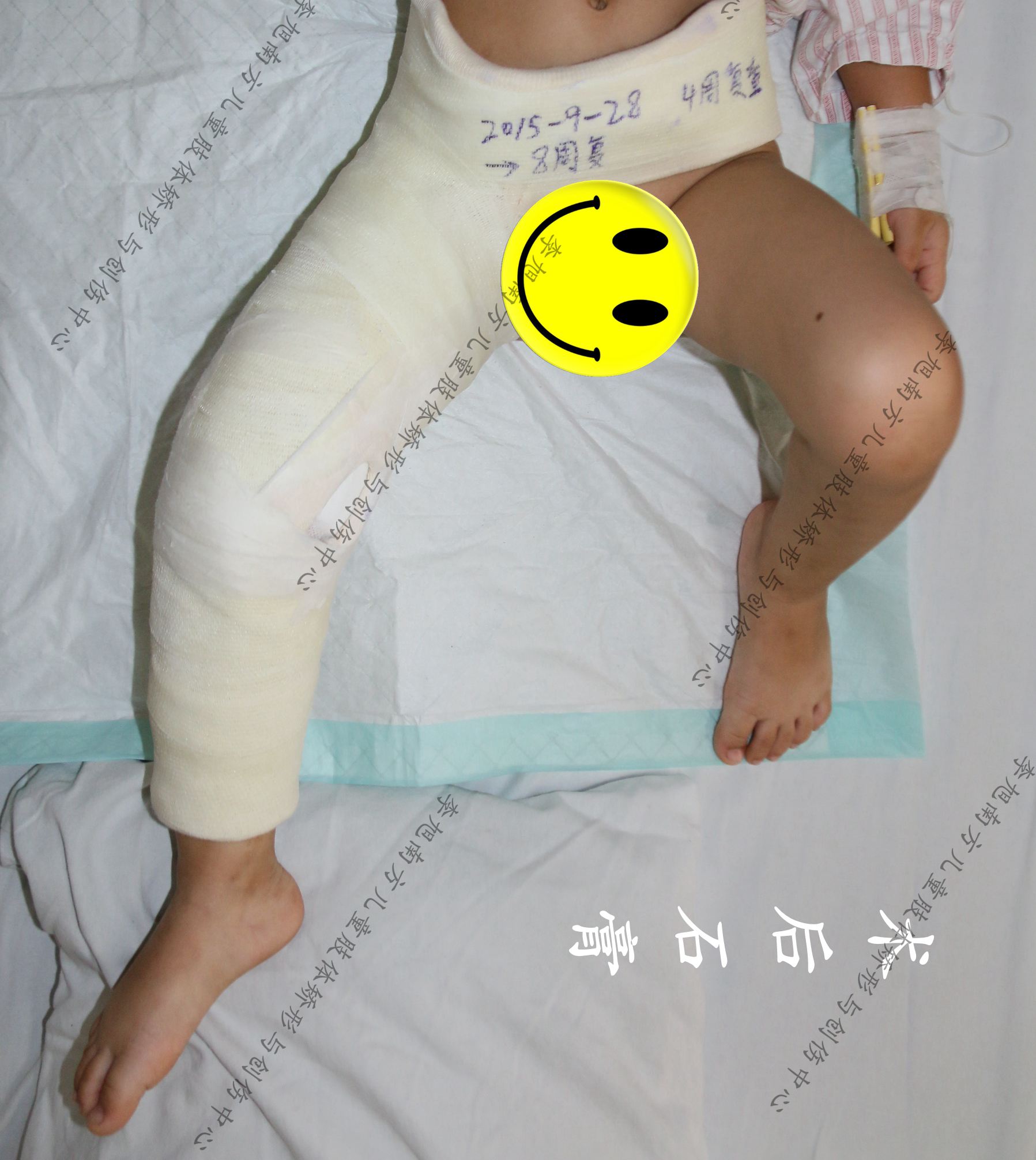 股骨干骨折术后功能锻炼,儿童股骨干骨折治疗方案