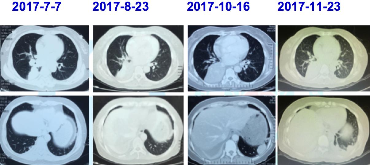 龙哥查房完整视频,肺腺癌治疗重大突破