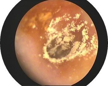 掏耳屎正确掏法,儿童掏耳屎正确方法