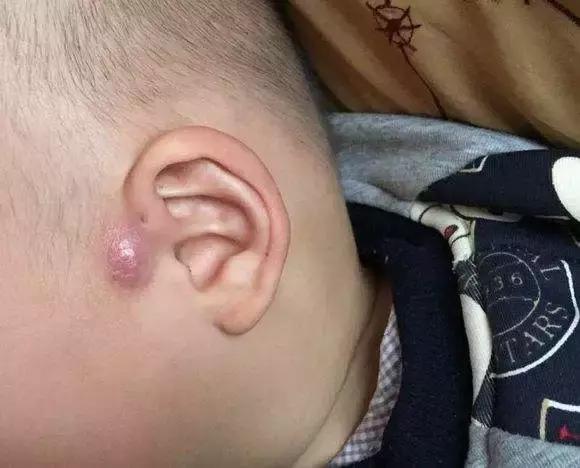 耳朵上方有个小孔流脓是怎么回事,耳朵的富贵洞能治好吗