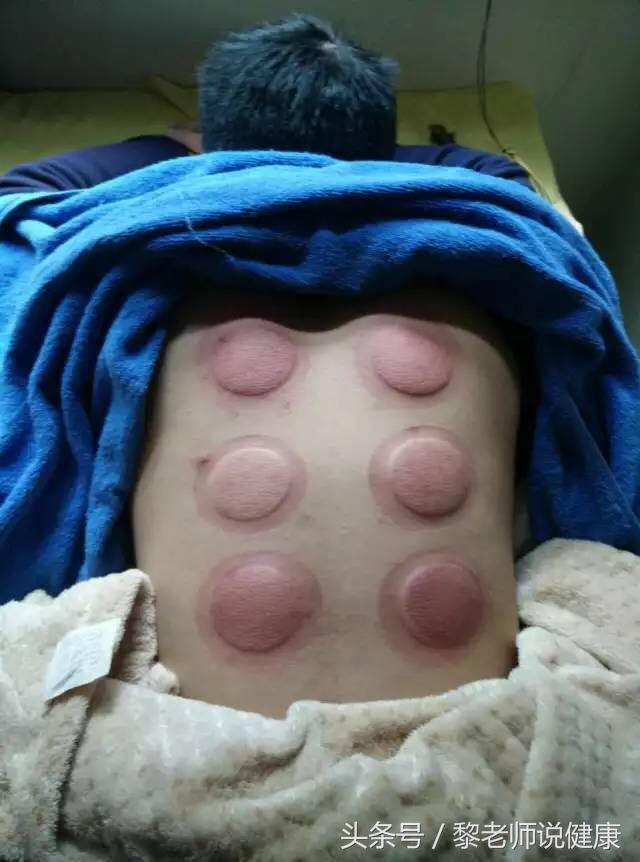 拔罐艾灸后的反应,拔罐20分钟起水泡怎么回事