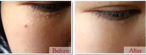 不用针挑刺,不用针挑刺还有什么办法能挑