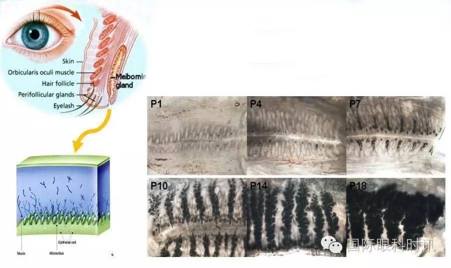 角膜会2016李炜教授:EDA基因突变鼠:一种新的睑板腺功能障碍相关性干眼动物模型