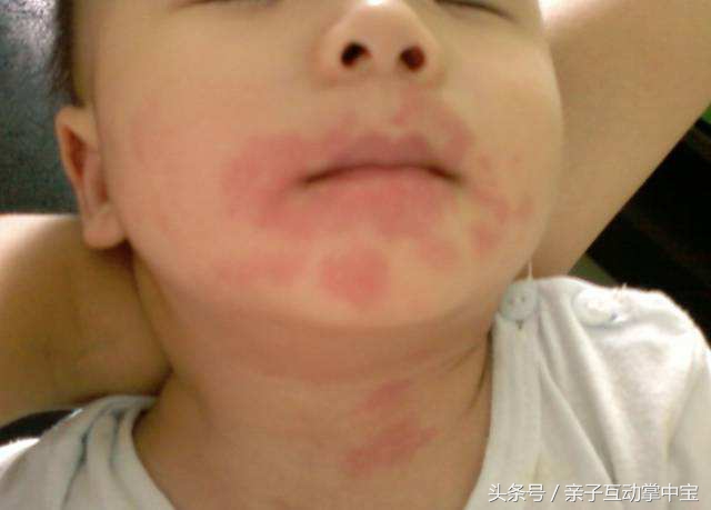 三岁孩子吃水果店老板送的芒果,嘴巴肿成香肠,宝妈找老板算账