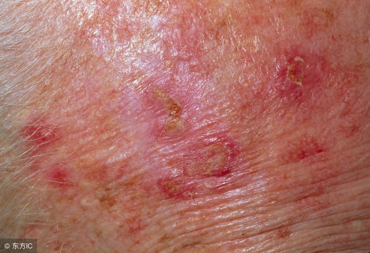 皮肤发硬要当回事，可能是皮肤癌征兆