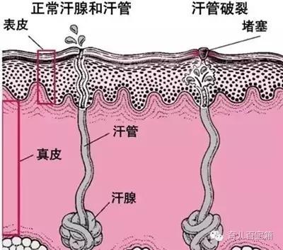 夏天宝宝长痱子能用炉甘石洗剂吗,夏季宝宝长痱子擦什么不会长