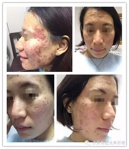 透明质酸护肤品功效,透明质酸是修复皮肤敏感成分