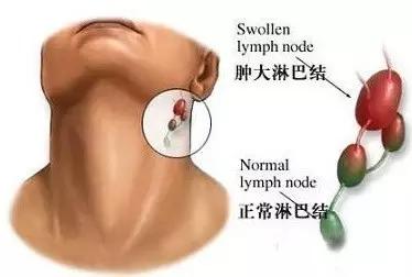小孩子耳后淋巴结肿大怎么治,小孩子脖子右侧淋巴结肿大