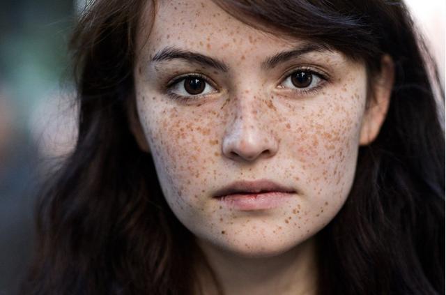 这样些治疗色素斑的方法最安全,你知道吗?